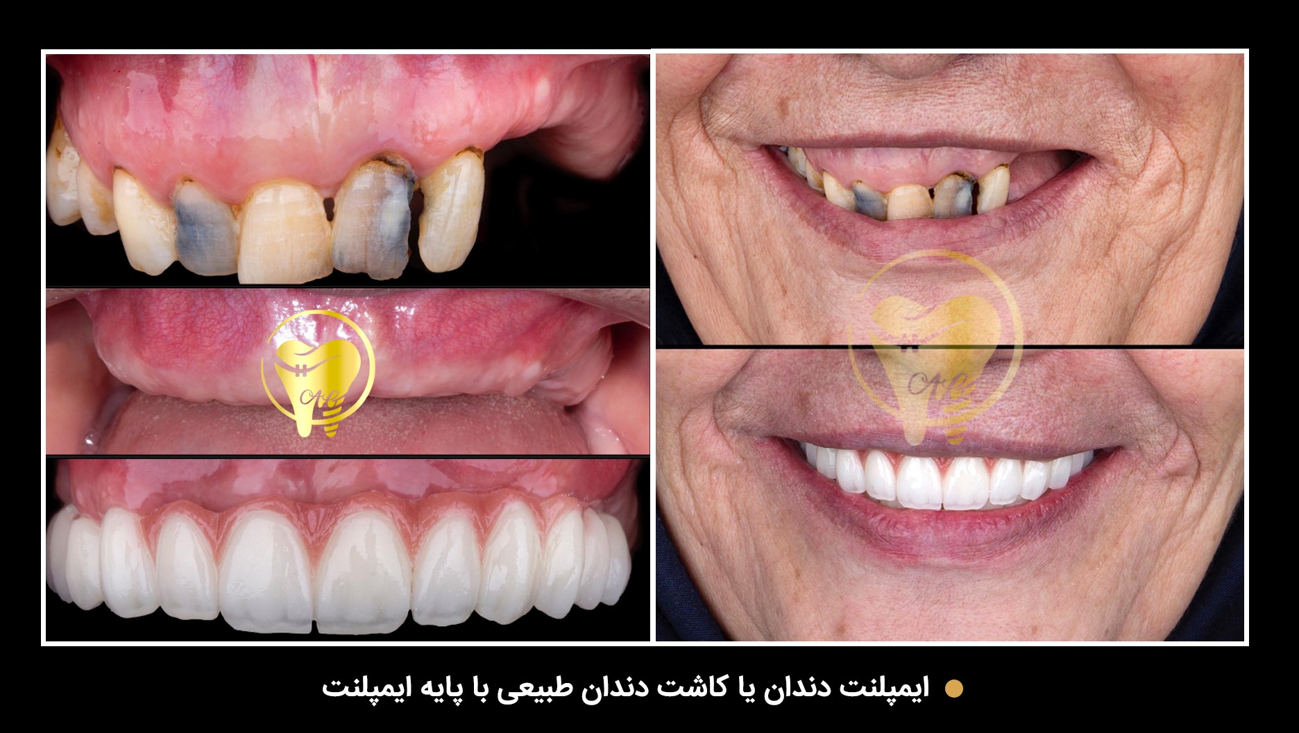 بازسازی کل دندانهای فک بالا و پایین با ایمپلنت و روکش های تمام سرامیکی